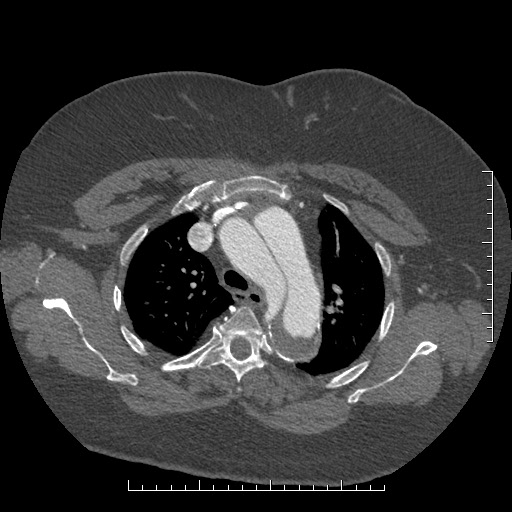 File:Aortic dissection- Stanford A (Radiopaedia 35729-37268 A 19).jpg