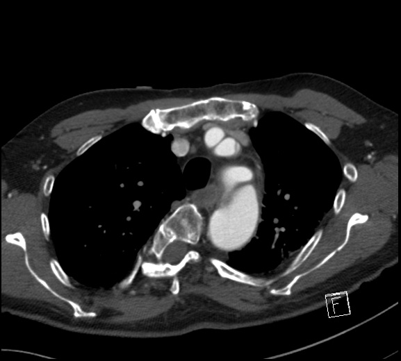File:Aortic dissection (CTPA) (Radiopaedia 75506-86750 A 25).jpg