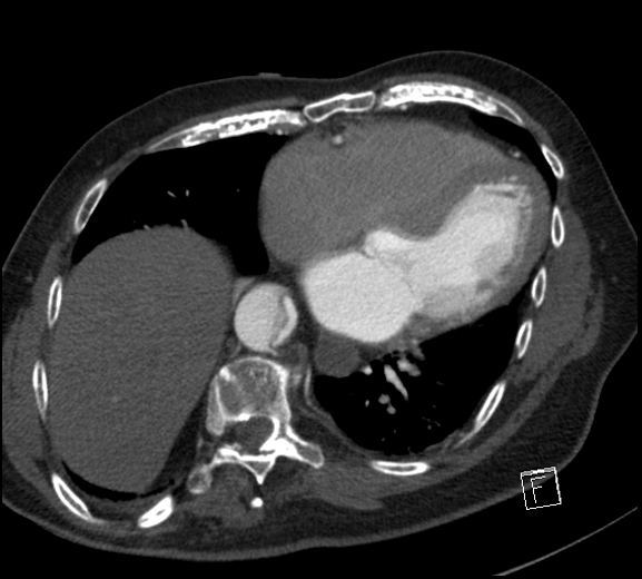 File:Aortic dissection (CTPA) (Radiopaedia 75506-86750 A 64).jpg