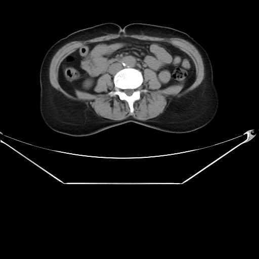 Aortic dissection (Radiopaedia 25350-25604 B 54).jpg
