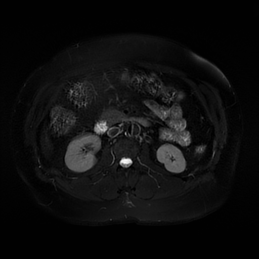 File:Aortic dissection (Radiopaedia 57969-64956 Axial T2 fat sat 34).jpg