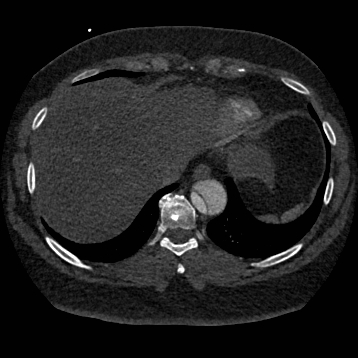 Aortic dissection (Radiopaedia 57969-64959 A 248).jpg