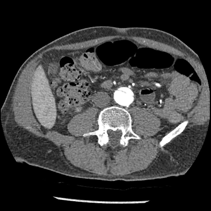 Aortic dissection - DeBakey Type I-Stanford A (Radiopaedia 79863-93115 A 59).jpg