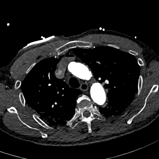 File:Aortic dissection - DeBakey type II (Radiopaedia 64302-73082 A 26).png