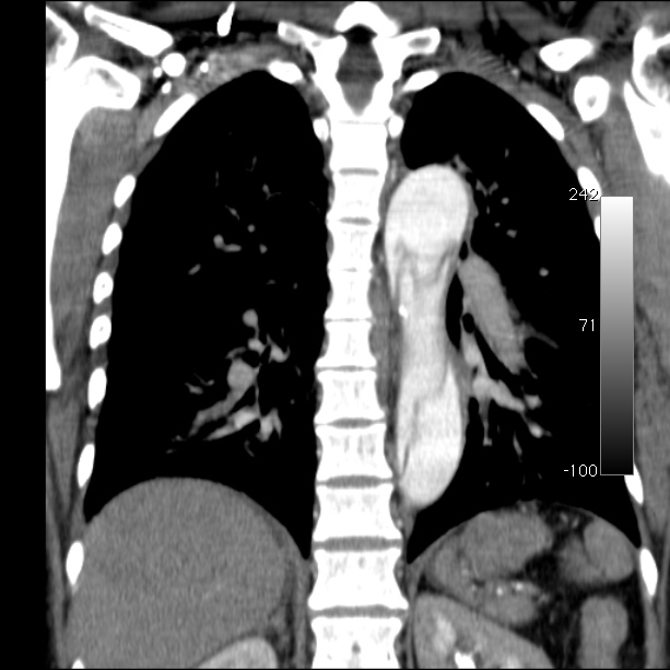Aortic dissection - Stanford type A (Radiopaedia 29247-29659 B 42).jpg
