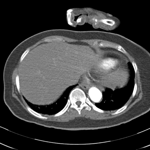 File:Aortic dissection - Stanford type A (Radiopaedia 39073-41259 A 65).png