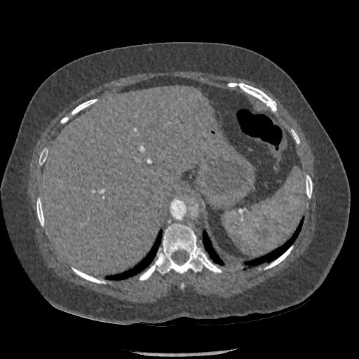 File:Aortic dissection - Stanford type B (Radiopaedia 88281-104910 A 89).jpg