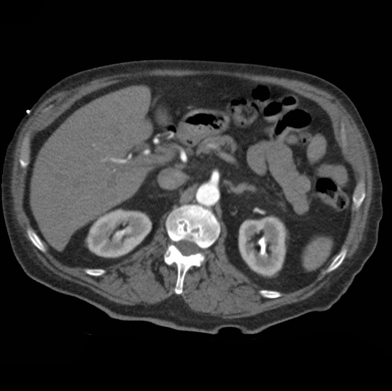 Aortic dissection with rupture into pericardium (Radiopaedia 12384-12647 A 58).jpg