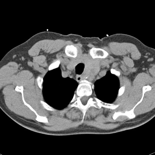 Aortic intramural hematoma (Radiopaedia 31139-31838 Axial non-contrast 8).jpg