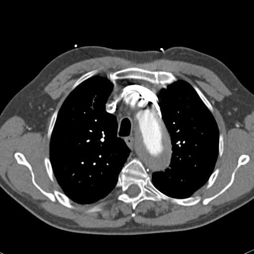 Aortic intramural hematoma (Radiopaedia 31139-31838 B 25).jpg
