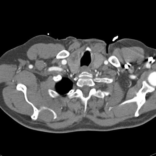 Aortic intramural hematoma (Radiopaedia 31139-31838 B 7).jpg