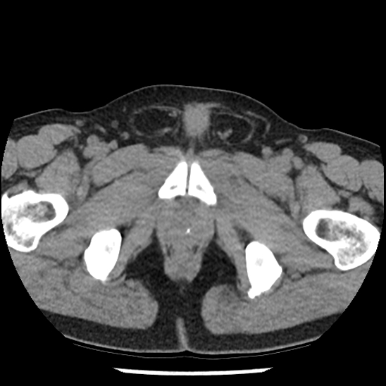 Aortic intramural hematoma (type B) (Radiopaedia 79323-92387 Axial non-contrast 118).jpg