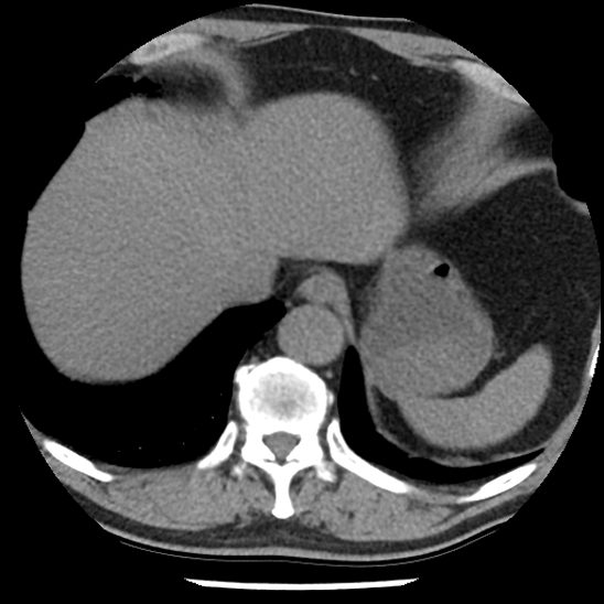 Aortic intramural hematoma (type B) (Radiopaedia 79323-92387 Axial non-contrast 46).jpg