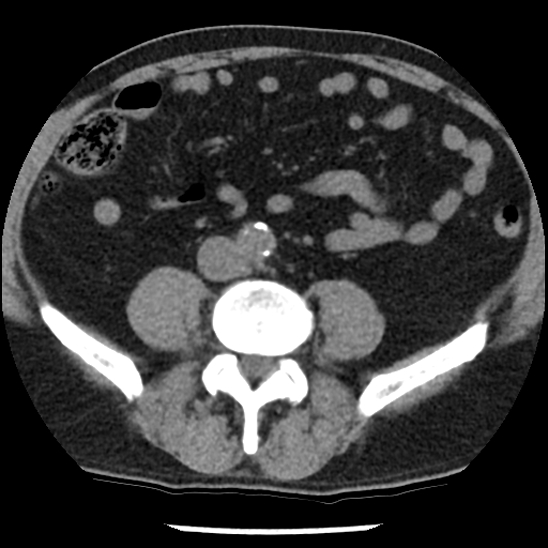 Aortic intramural hematoma (type B) (Radiopaedia 79323-92387 Axial non-contrast 83).jpg