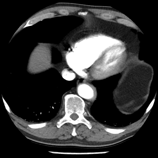 Aortic intramural hematoma (type B) (Radiopaedia 79323-92387 B 43).jpg