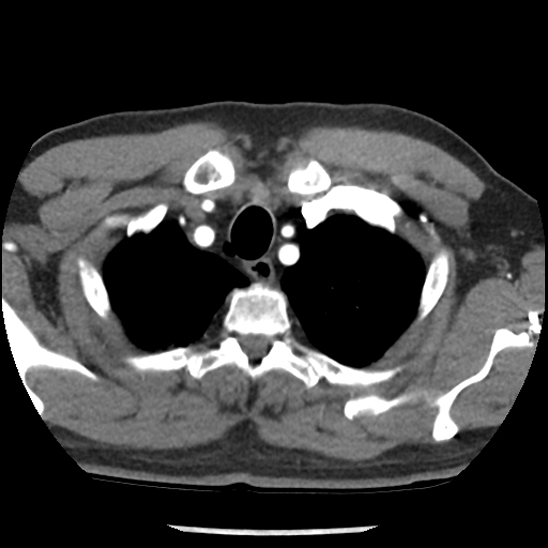 Aortic intramural hematoma (type B) (Radiopaedia 79323-92387 B 5).jpg