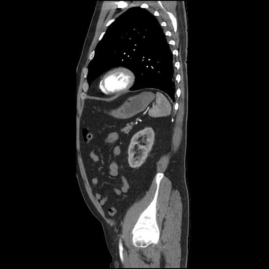 Aortic intramural hematoma (type B) (Radiopaedia 79323-92387 H 42).jpg