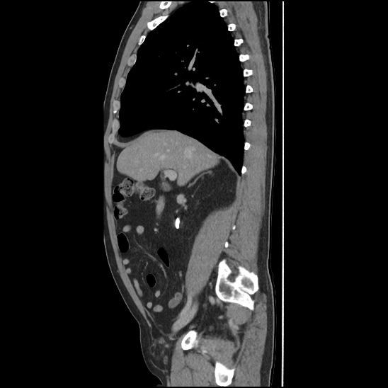 Aortic intramural hematoma (type B) (Radiopaedia 79323-92387 Sagittal C+ delayed 15).jpg