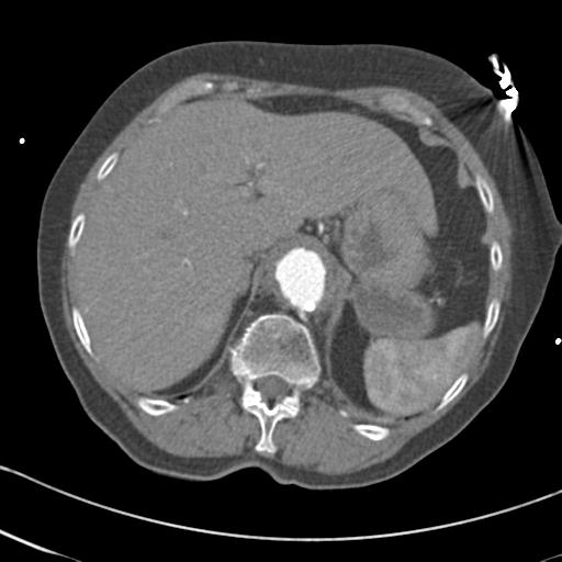 Aortic intramural hematoma from penetrating atherosclerotic ulcer (Radiopaedia 31137-31836 A 76).jpg
