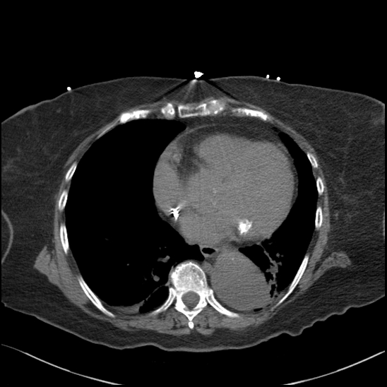 File:Aortic intramural hematoma with dissection and intramural blood pool (Radiopaedia 77373-89491 Axial non-contrast 62).jpg