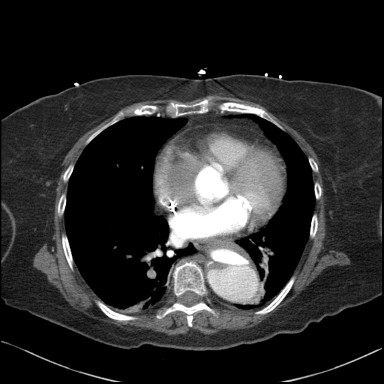 File:Aortic intramural hematoma with dissection and intramural blood pool (Radiopaedia 77373-89491 B 71).jpg