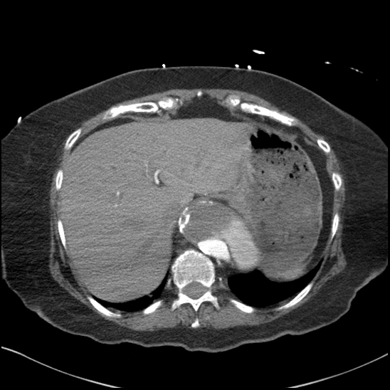 Aortic intramural hematoma with dissection and intramural blood pool (Radiopaedia 77373-89491 B 96).jpg