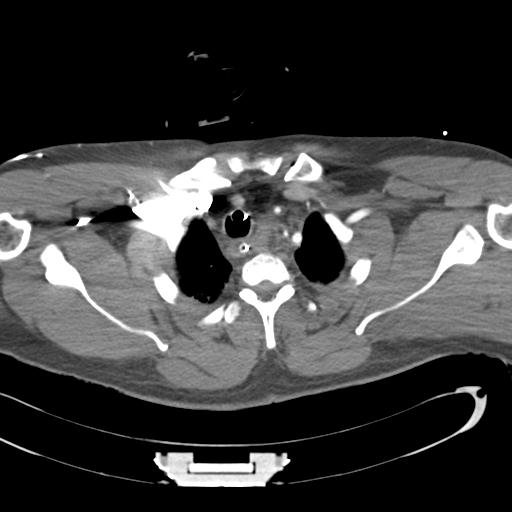 Aortic transection, diaphragmatic rupture and hemoperitoneum in a complex multitrauma patient (Radiopaedia 31701-32622 A 15).jpg