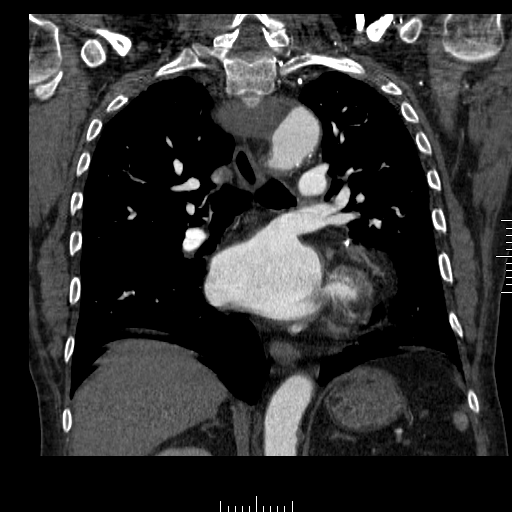 File:Aorto-coronary bypass graft aneurysms (Radiopaedia 40562-43157 B 26).png