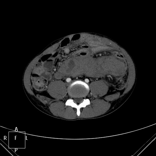 File:Aorto-left renal vein fistula (Radiopaedia 45534-49628 A 48).jpg