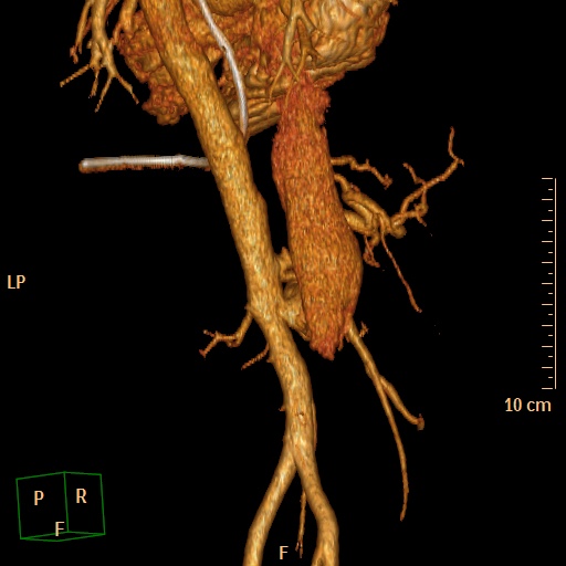 File:Aorto-left renal vein fistula (Radiopaedia 45534-49628 D 26).jpg
