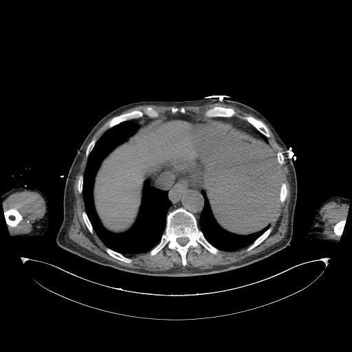 Aortoduodenal fistula (Radiopaedia 75286-86415 Axial non-contrast 3).jpg