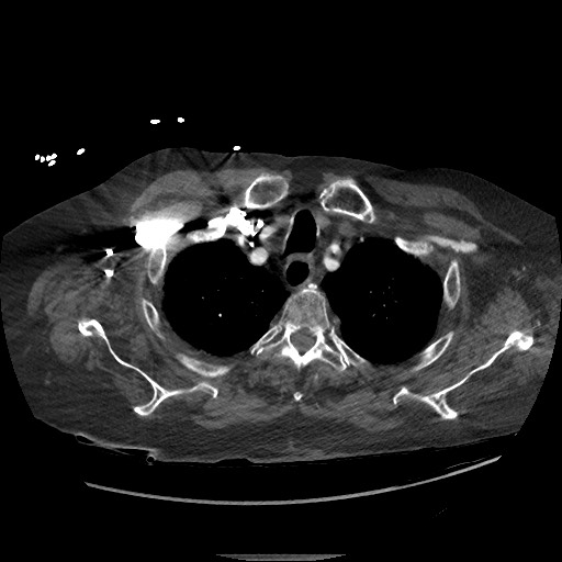 File:Aortoesophageal fistula with endovascular repair (Radiopaedia 73781-84592 Axial C+ CTPA 9).jpg
