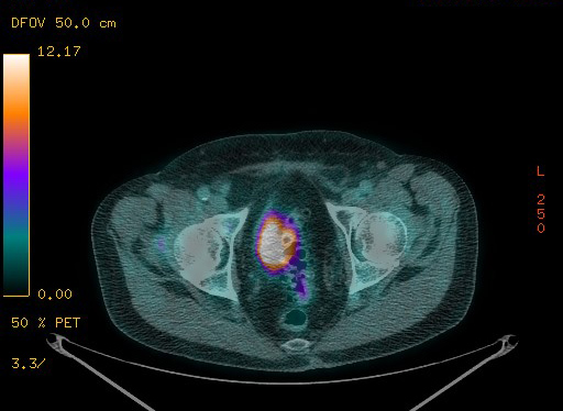 Appendiceal adenocarcinoma complicated by retroperitoneal abscess (Radiopaedia 58007-65041 Axial PET-CT 183).jpg