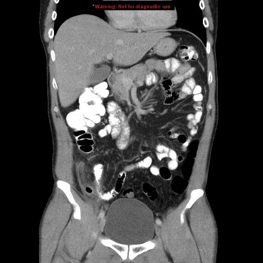 File:Appendicitis and renal cell carcinoma (Radiopaedia 17063-16760 B 12).jpg