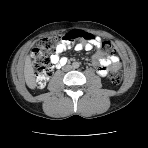 Appendicitis complicated by post-operative collection (Radiopaedia 35595-37113 A 37).jpg