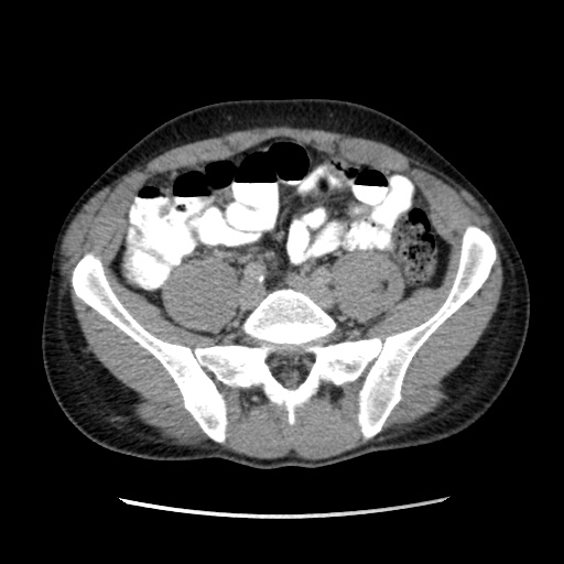 File:Appendicitis complicated by post-operative collection (Radiopaedia 35595-37113 A 52).jpg