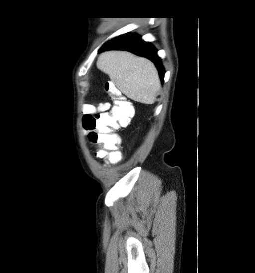 Appendicitis with localized perforation and abscess formation (Radiopaedia 49035-54130 C 8).jpg