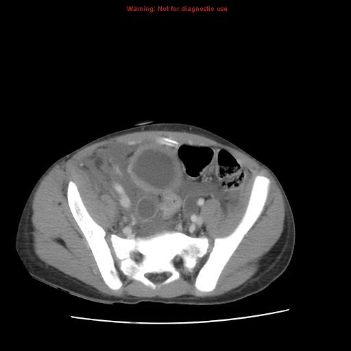 File:Appendicitis with phlegmon (Radiopaedia 9358-10046 A 55).jpg