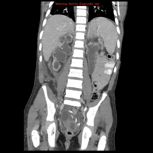 File:Appendicitis with phlegmon (Radiopaedia 9358-10046 B 46).jpg