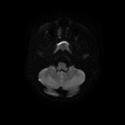 Arachnoid cyst - middle cranial fossa (Radiopaedia 67671-77088 Axial DWI 6).jpg