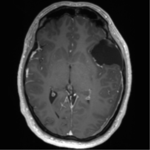 Arachnoid cyst with subdural hematoma (Radiopaedia 85892-101743 Axial T1 C+ 43).png