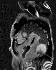 File:Arrhythmogenic right ventricular cardiomyopathy (Radiopaedia 57972-64966 D 11).jpg