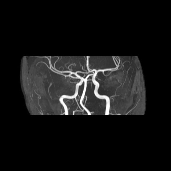File:Artery of Percheron infarct (Radiopaedia 40966-43676 G 27).jpg