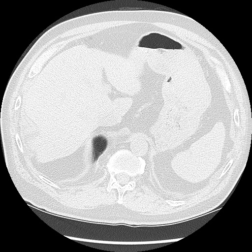 Asbestos-related pleural disease (Radiopaedia 74366-85250 Axial lung window 106).jpg