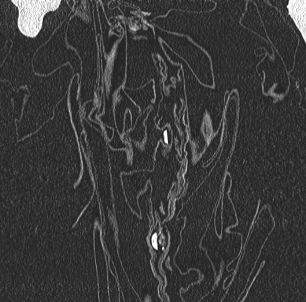 Aspergilloma- with Monod sign (Radiopaedia 44737-48532 Coronal lung window 89).jpg