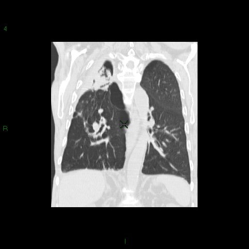 File:Aspergilloma (Radiopaedia 14842-14787 Coronal lung window 23).jpg