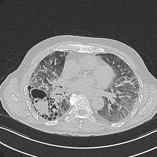 File:Aspergilloma on background pulmonary fibrosis (Radiopaedia 60942-68757 B 29).jpg