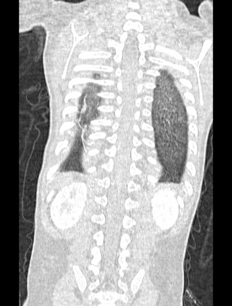 Asplenia syndrome (Radiopaedia 73083-83792 Coronal lung window 119).jpg