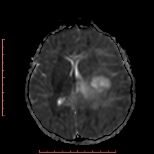 Astroblastoma (Radiopaedia 74287-85162 Axial ADC 34).jpg