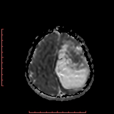 Astroblastoma (Radiopaedia 74287-85162 Axial ADC 55).jpg